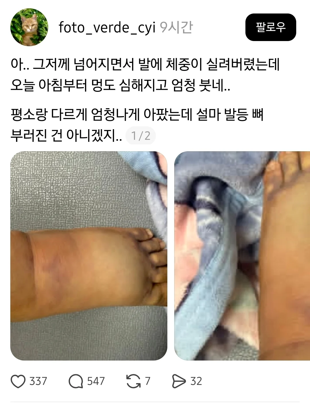 그저께 넘어졌는데 발이 너무 아파 | 인스티즈