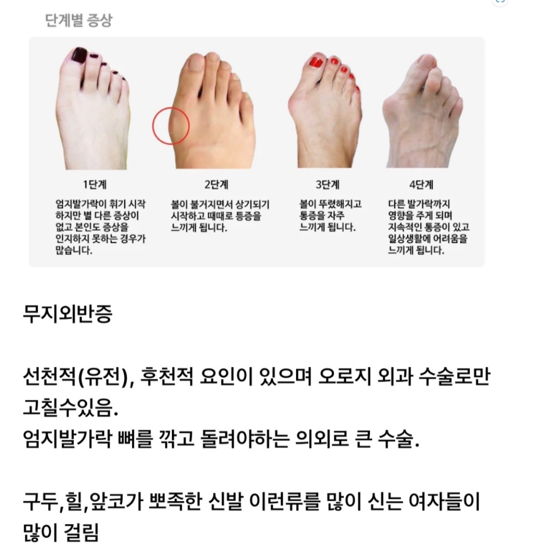 여자들이 걸리기 쉬운 발 질환 | 인스티즈