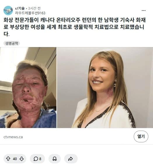 엄청나게 발전한 화상치료 최신 기술 | 인스티즈