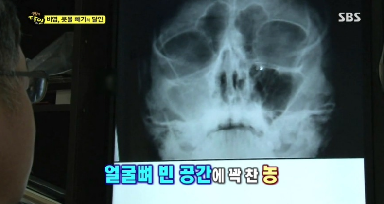 보는 내가 다 후련한 생활의달인 비염/콧물의 달인편.jpg (충격주의) | 인스티즈