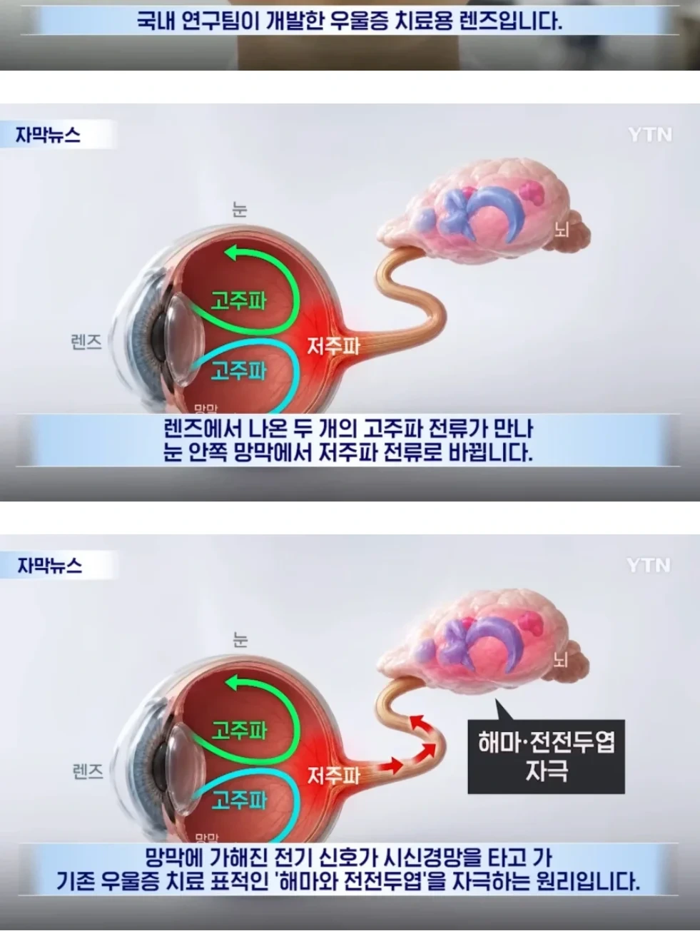 상상도 못한 국내 우울증 치료제 개발 근황 | 인스티즈