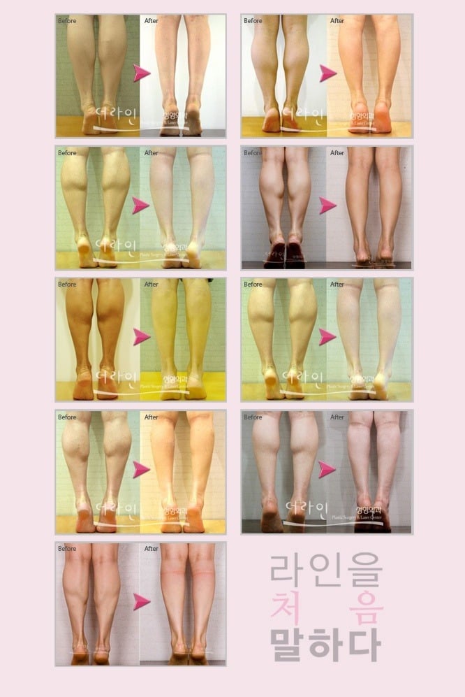잘맞는 사람은 신세계라고하는 보톡스.jpg | 인스티즈