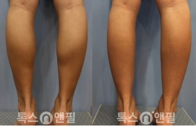 잘맞는 사람은 신세계라고하는 보톡스.jpg | 인스티즈