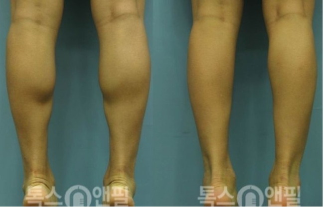 잘맞는 사람은 신세계라고하는 보톡스.jpg | 인스티즈