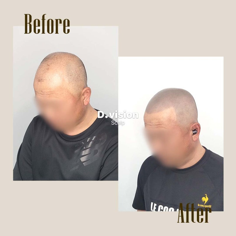 역대급으로 망해서 사진도 못 찍을 정도였다는 두피 문신.jpg | 인스티즈