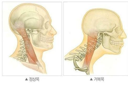 '거북목' 되지 말기 tip | 인스티즈