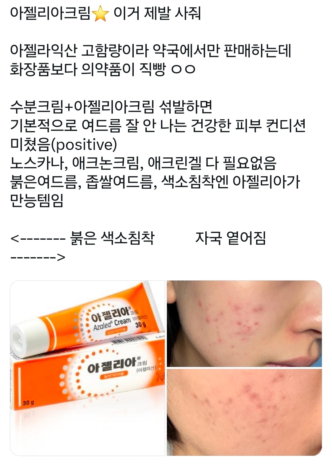 요즘 여드름 약국템으로 붐업되는 연고 | 인스티즈
