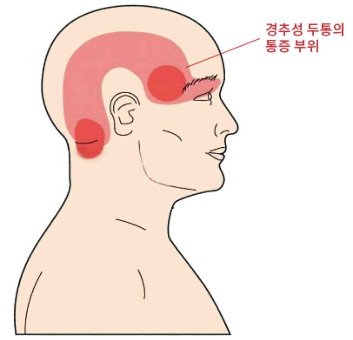 겪으면 진짜 고통스럽다는 경추성 두통...jpg | 인스티즈
