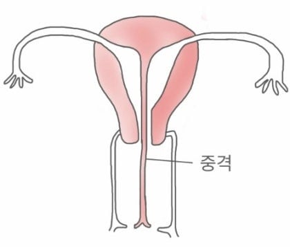 들어는 봤나 "중복자궁", 여성의 n%가 갖고있다는 자궁기형 | 인스티즈