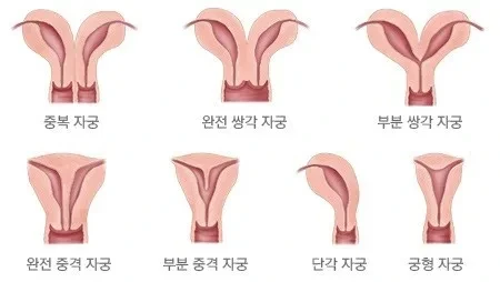 들어는 봤나 "중복자궁", 여성의 n%가 갖고있다는 자궁기형 | 인스티즈