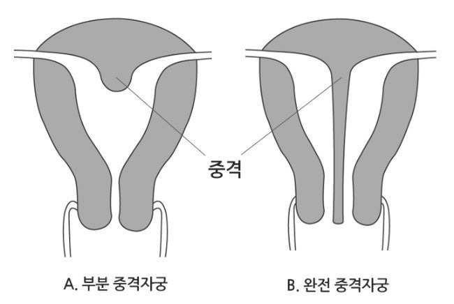들어는 봤나 "중복자궁", 여성의 n%가 갖고있다는 자궁기형 | 인스티즈
