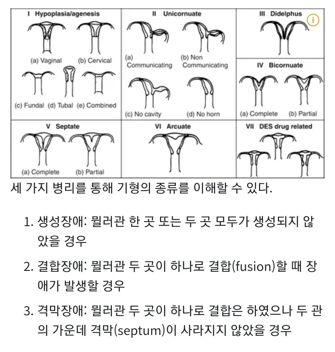 들어는 봤나 "중복자궁", 여성의 n%가 갖고있다는 자궁기형 | 인스티즈