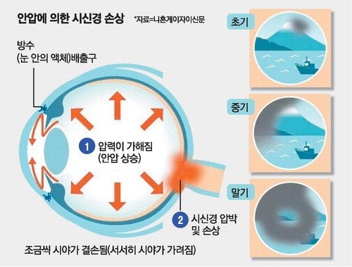 실명 원인 1위 녹내장… 40세 안과검진이 평생시력 좌우 | 인스티즈