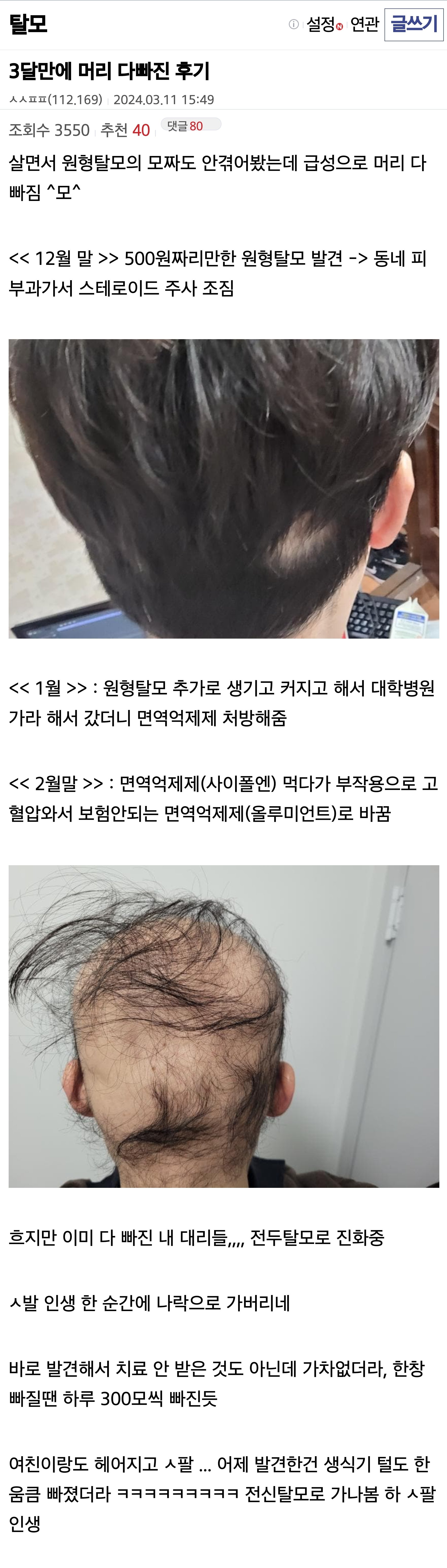 3달만에 머리 다빠진 후기 | 인스티즈
